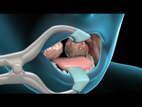 Tonsillectomy & Adenoidectomy | Nucleus Health