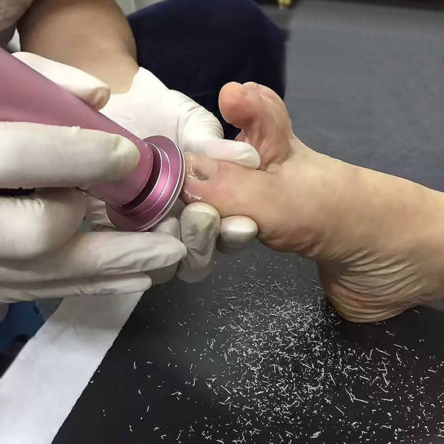 Professional Callus Remover