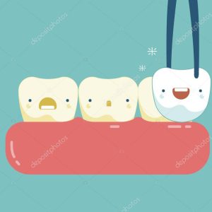 Veneers teeth of dental concept